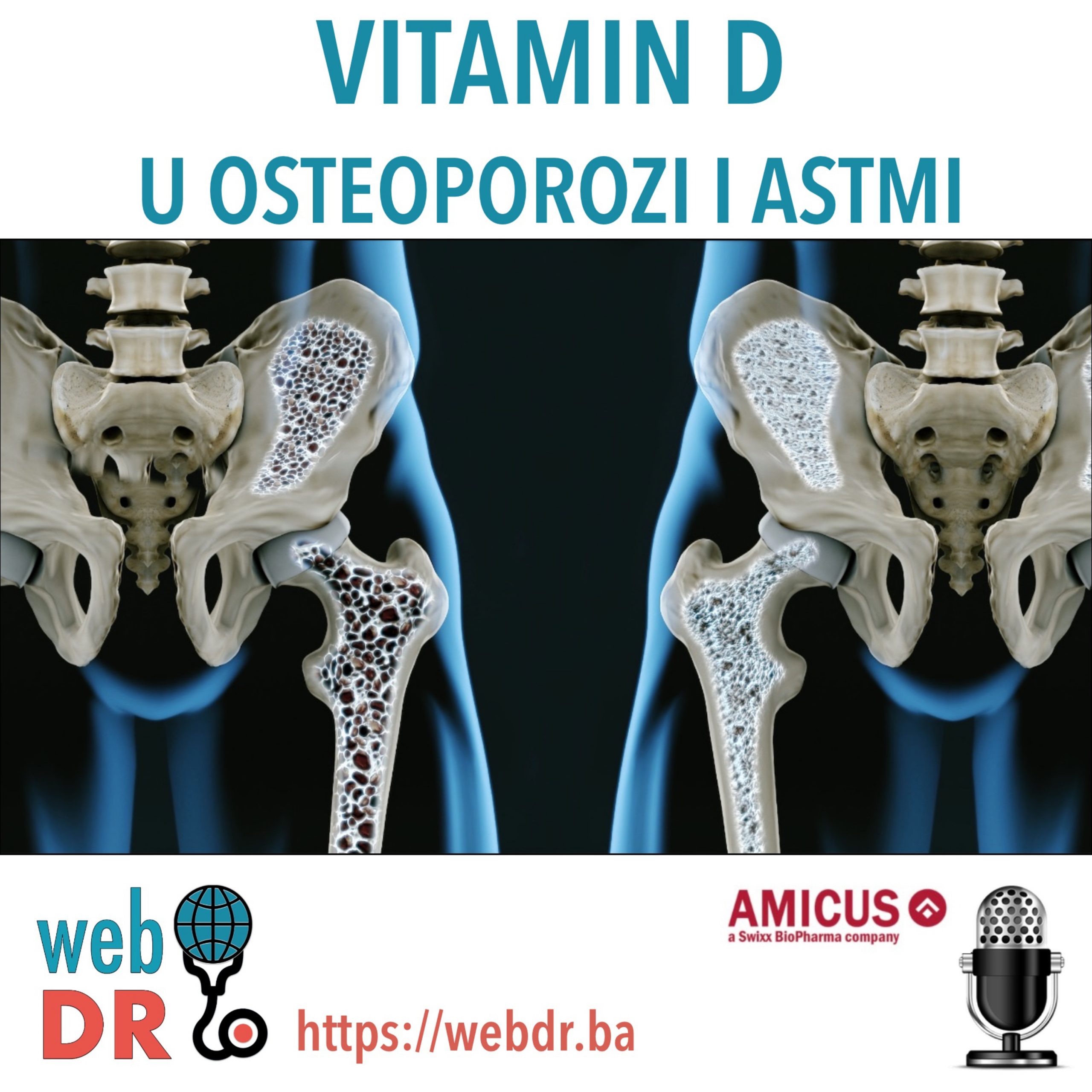 Vitamin D u osteoporozi i astmi